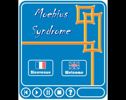 Moebius Syndrome